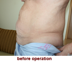 plastic-surgery-tummy-tuck